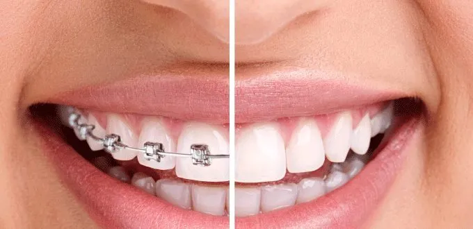 Các loại mắc cài niềng răng phổ biến được quan tâm nhất hiện nay - nên niềng răng sứ hay kim loại